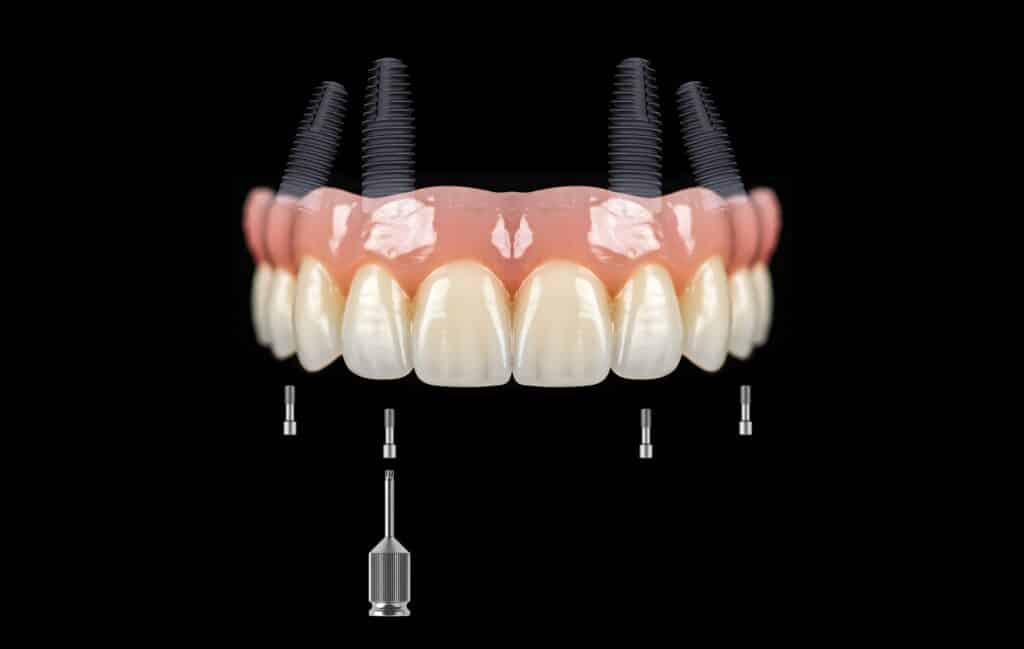 dental implants near me